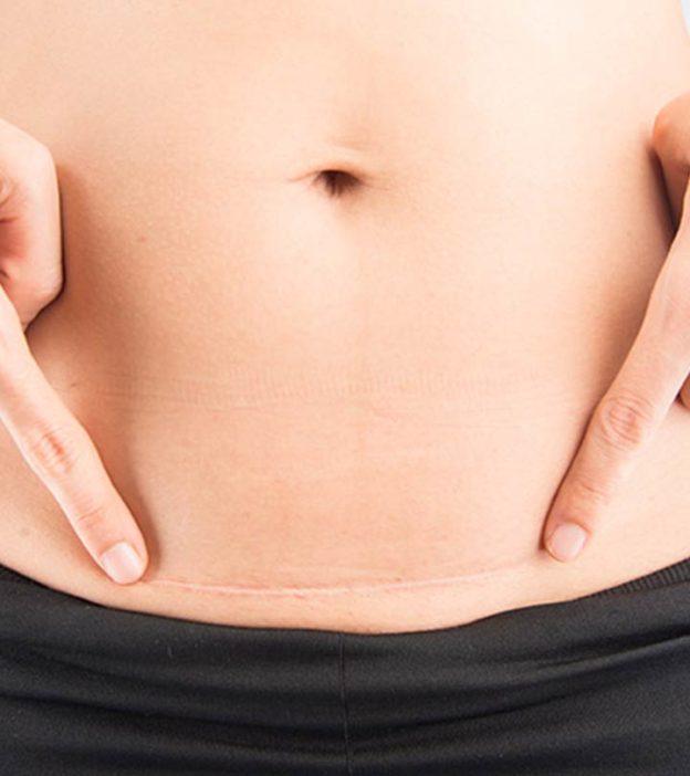 What Really Happens To Your Stomach After A Cesarean?