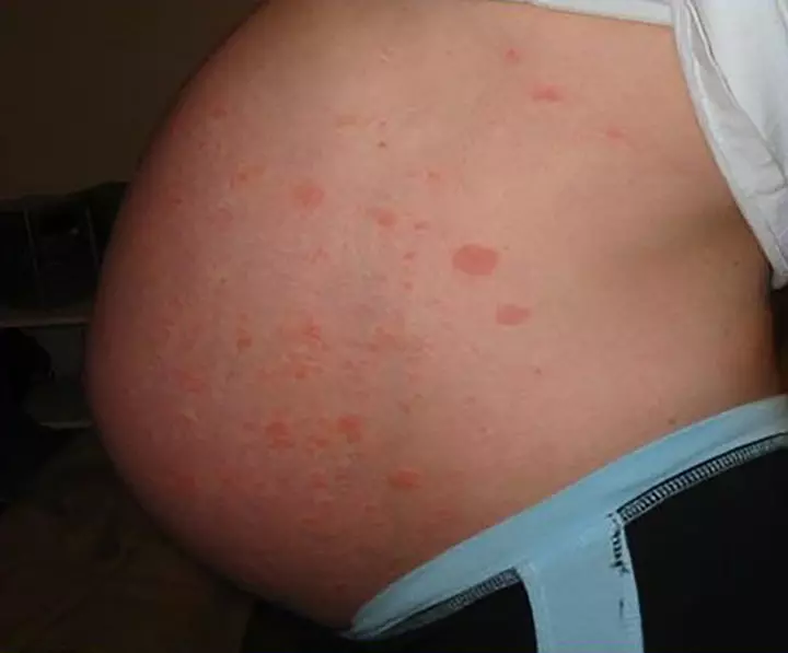 Pregnancy Rashes