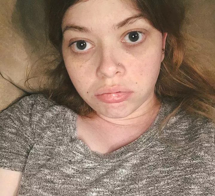 Those Much-Dreaded Pimples