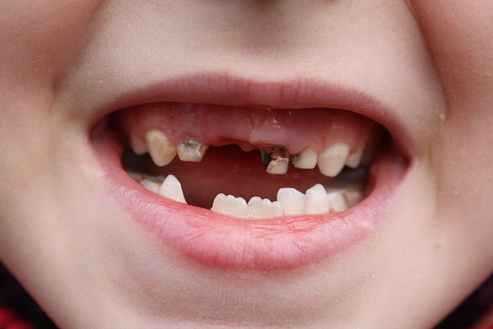儿童牙医解释奶瓶对婴儿牙齿有害吗