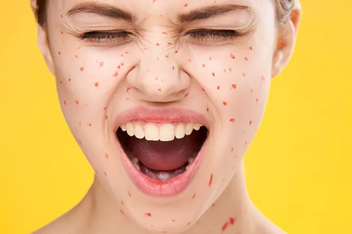 Chicken Pox Chicken Pox