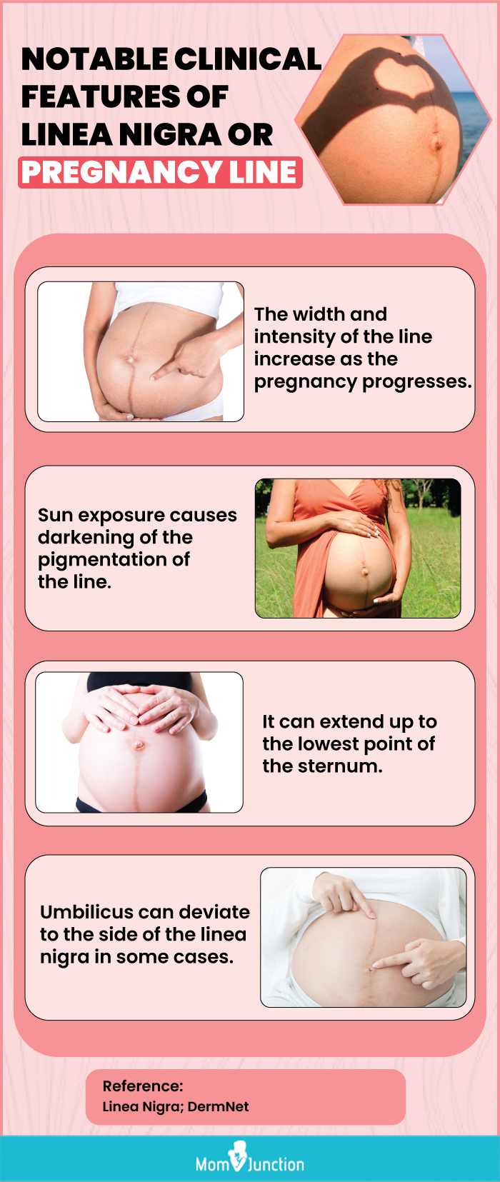 notable clinical features of liea nigra or pregnancy line (infographic)