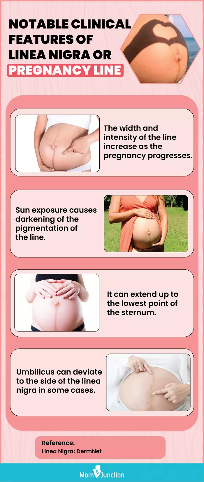 notable clinical features of liea nigra or pregnancy line (infographic)