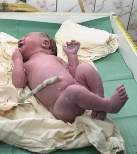 Delayed Cord Clamping: Benefits And Risks