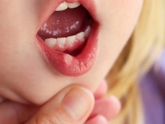 5 Ways To Treat Canker Sores In Toddlers