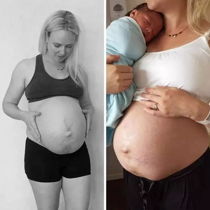 Before And After 36-Week Pregnant And 24 Hours Post Childbirth Before And After 36-Week Pregnant And 24 Hours Post Childbirth