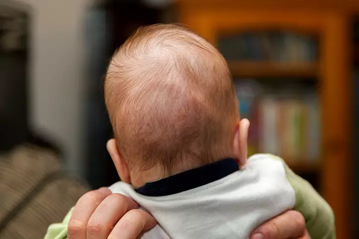 Brachycephaly, flat head syndrome