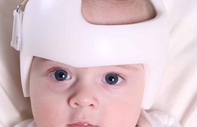 Baby Flat Head Syndrome (Plagiocephaly): Causes & Treatment