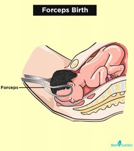 Forceps Delivery: Types, Risks Involved And Prevention