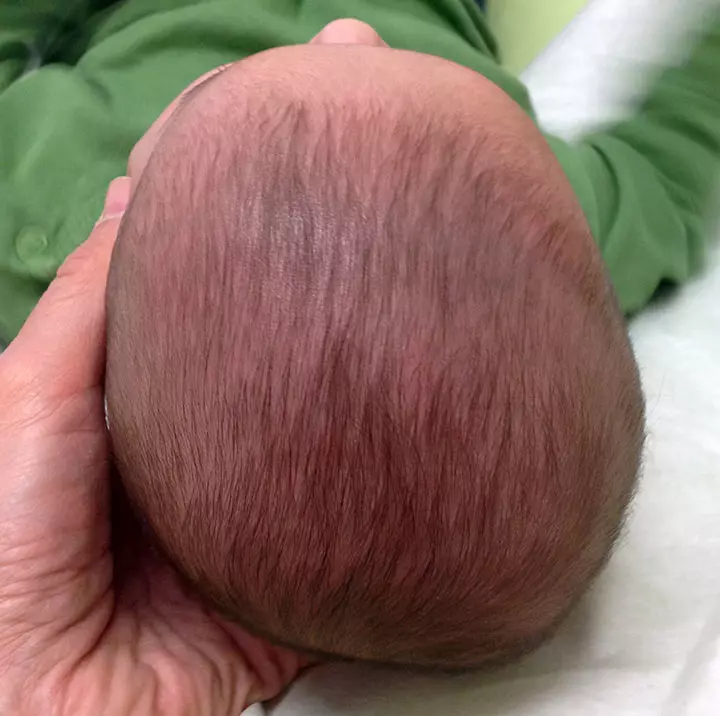 Plagiocephaly, flat head syndrome