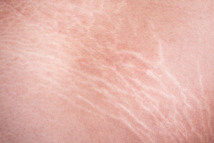 Stretch marks are fine pink lines on the breasts