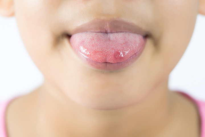 What Results In Canker Sores