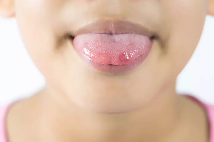 What Results In Canker Sores