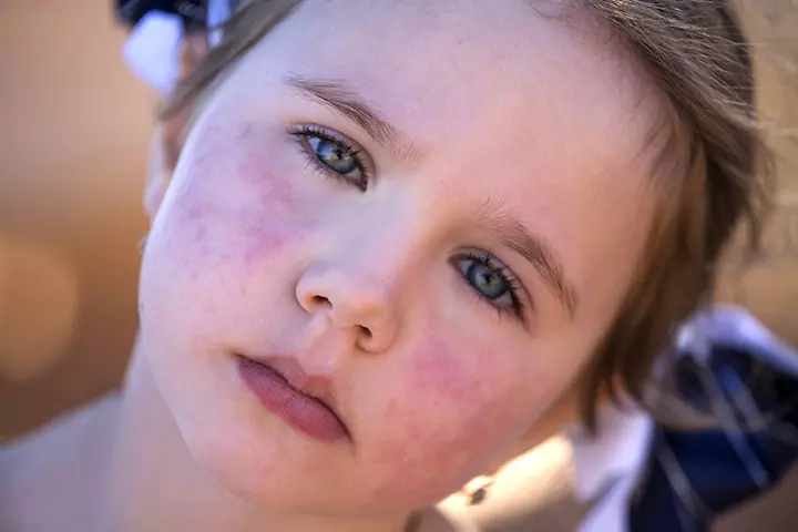 About Slapped Cheek Syndrome