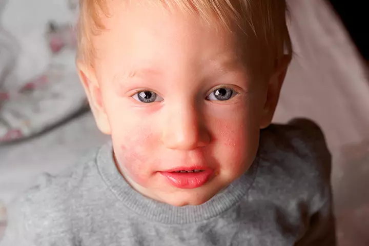 How Is This Infection Spread How Is This Infection Spread