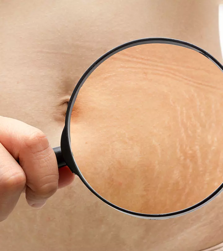 Pregnancy Stretch Marks Types Of Treatment And Prevention