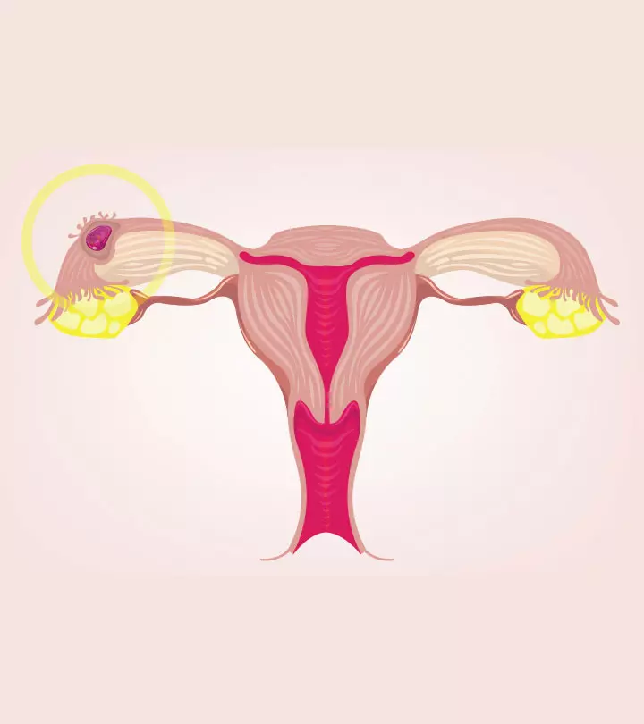 अस्थानिक गर्भावस्था - कारण, लक्षण और इलाज | Ectopic Pregnancy In Hindi