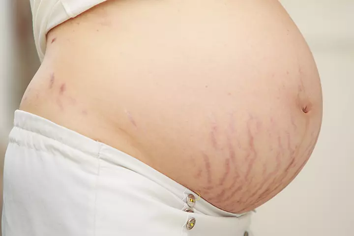 Treatment for stretch marks