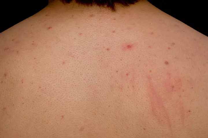 Acne Conglobata