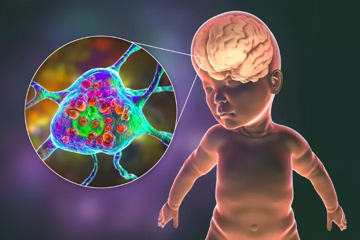 Problems in the brain can cause thid condition in babies.