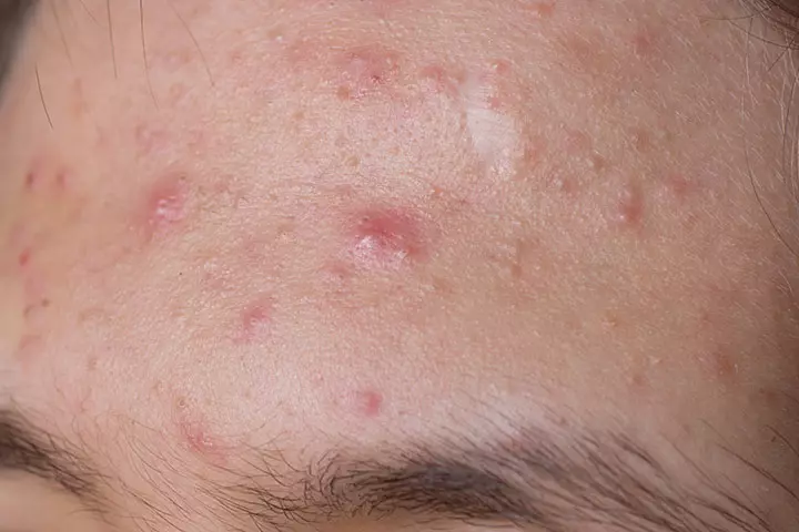 Papules (Early Pimples)