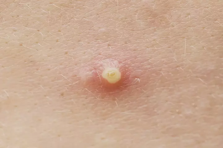 Pustules