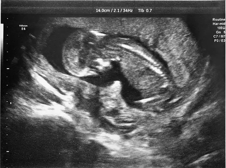 This Girl Was Born Already Pregnant ... With Twins