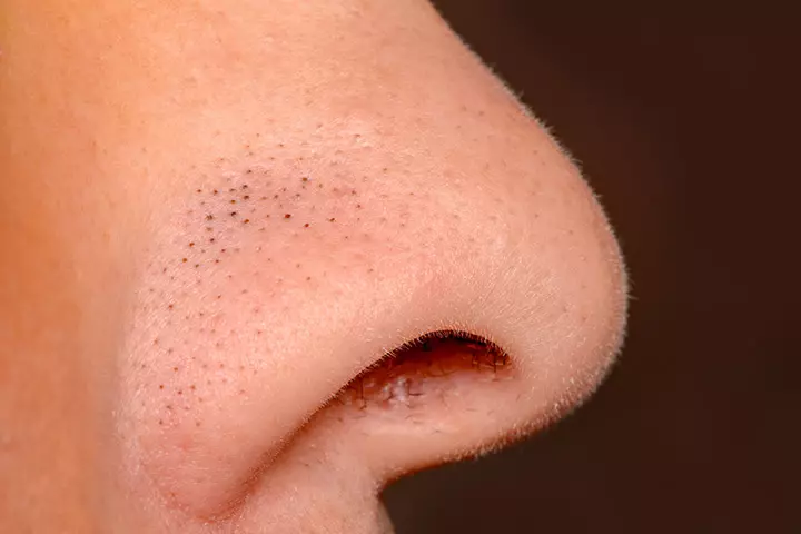 Whiteheads & Blackheads
