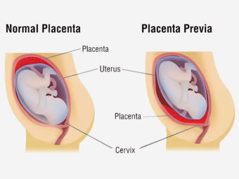 प्लेसेंटा प्रिविआ (अपरा नीचे स्थित होना) के उपचार, लक्षण और कारण | Placenta Previa In Hindi