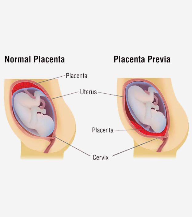 प्लेसेंटा प्रिविआ (अपरा नीचे स्थित होना) के उपचार, लक्षण और कारण | Placenta Previa In Hindi