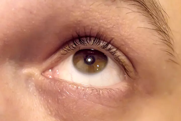 Dry Eyes