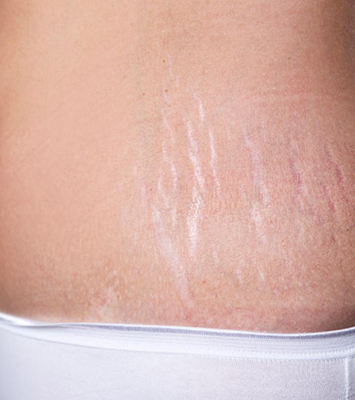 गर्भावस्था के स्ट्रेच मार्क्स हटाने के उपाय | Stretch Marks Hatane Ke Upay