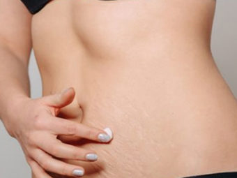 You Should Really Try This If You're Struggling With Stretch Marks