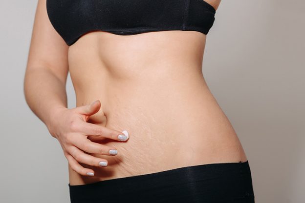 You Should Really Try This If You're Struggling With Stretch Marks
