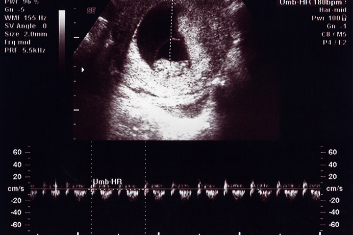 10th Week Ultrasound: Baby Development, Abnormalities And More