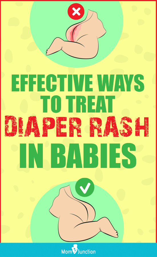 12 Effective Ways To Treat Yeast Diaper Rash In Babies