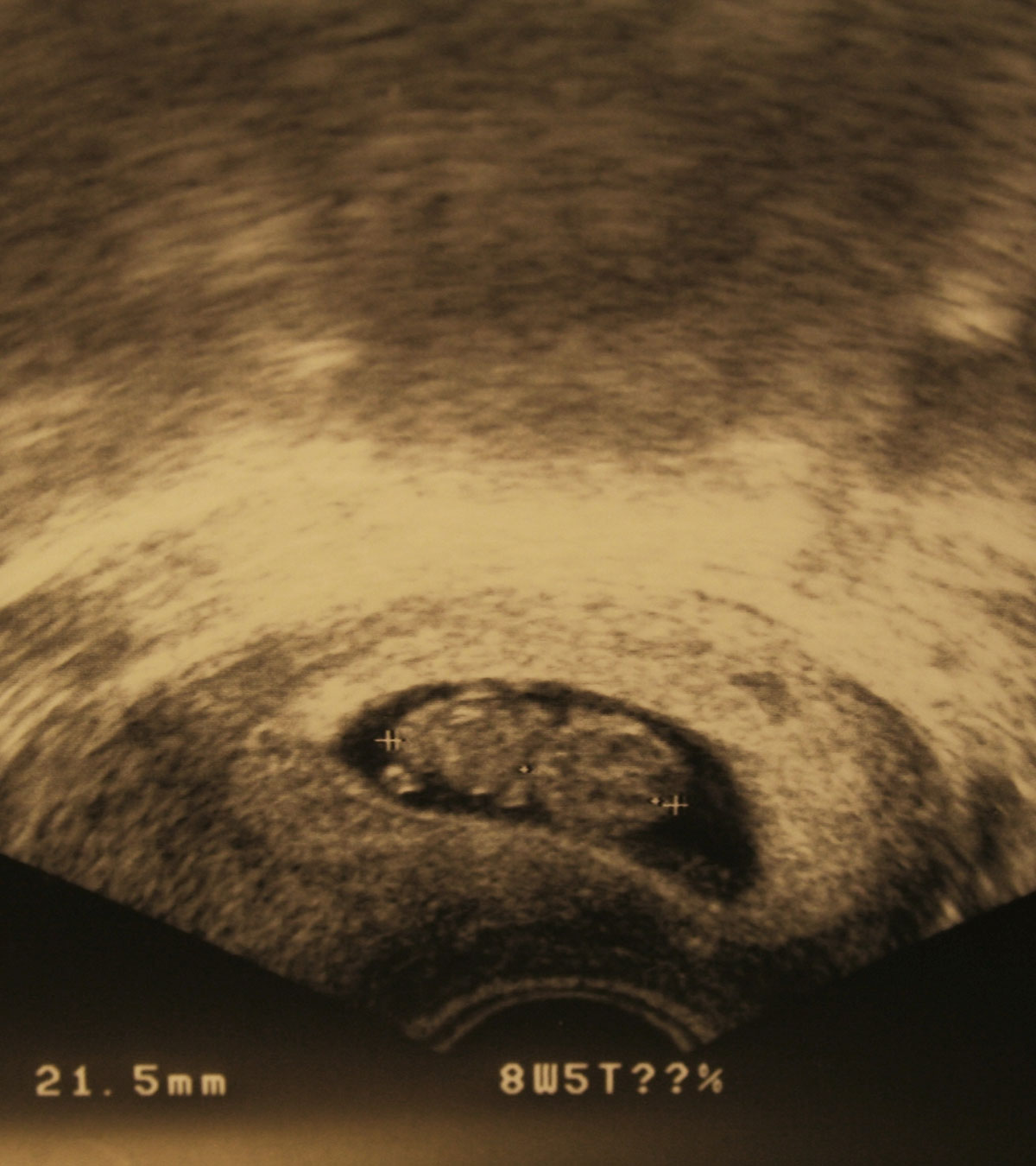 8th Week Ultrasound: Baby Development, Abnormalities And More