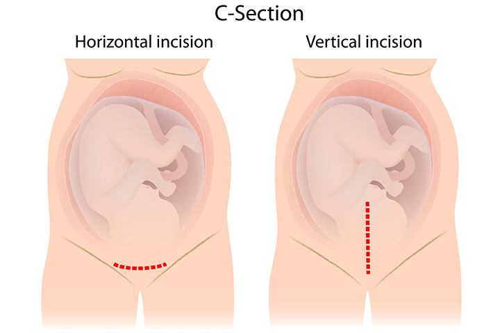 Uterine incision