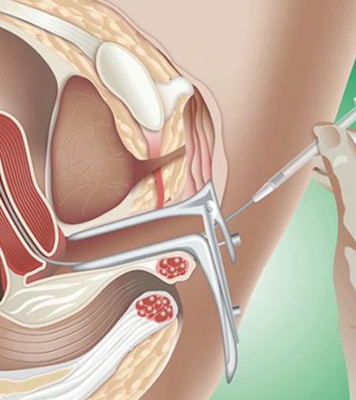 आईयूआई (IUI) कैसे होता है? प्रक्रिया, उपचार और सफलता के टिप्स