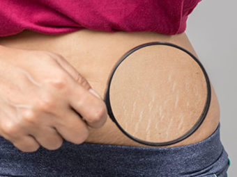 4 Myths Related To Stretch Marks: And A Solution That Actually Works!