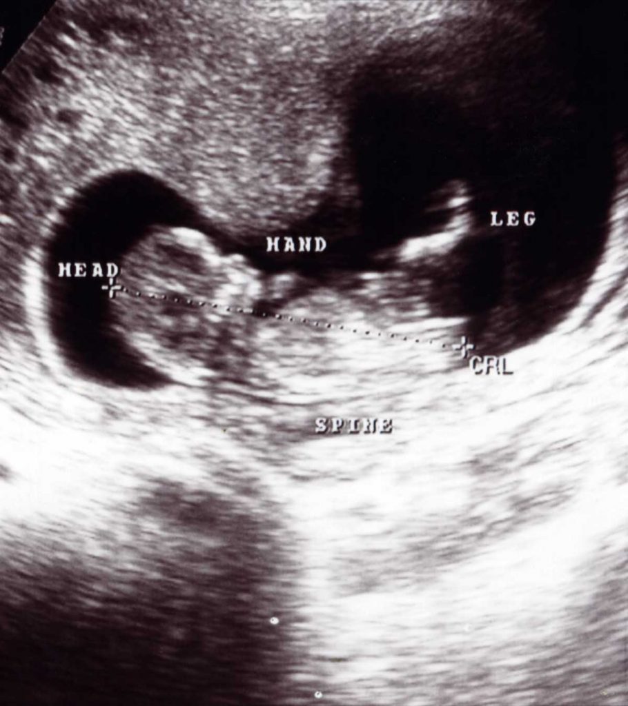 Chart measurements ultrasound age gestational Umbilical arterial
