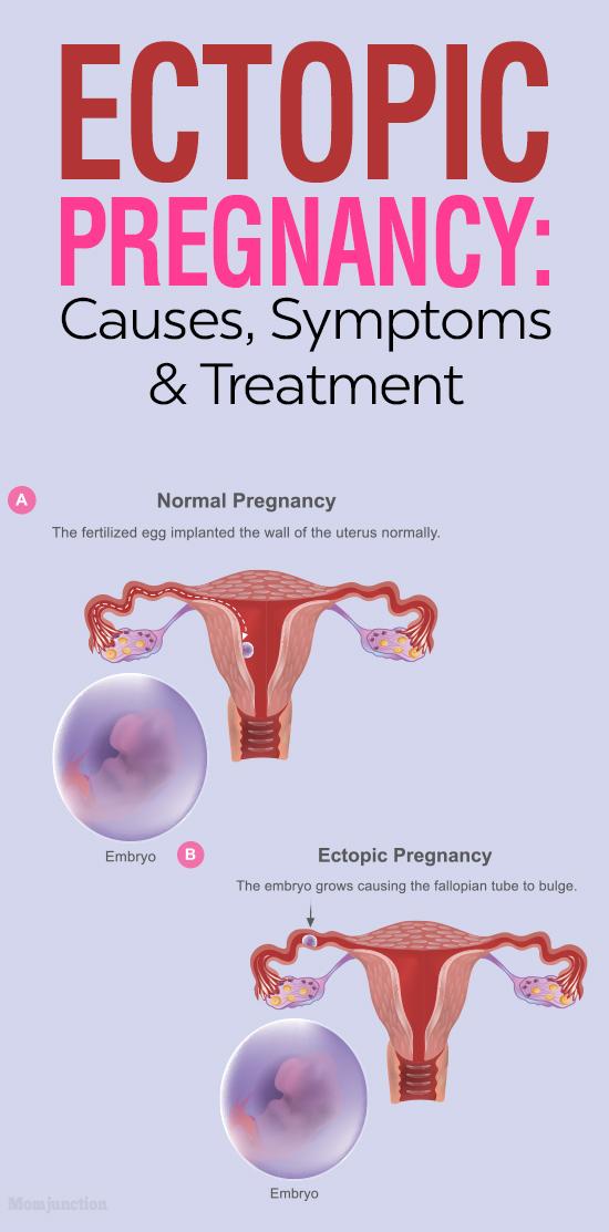 Ectopic Pregnancy Causes Symptoms Treatment And Risks 4484