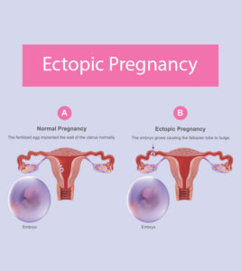 Ectopic Pregnancy: Causes, Symptoms, Treatment, And Risks