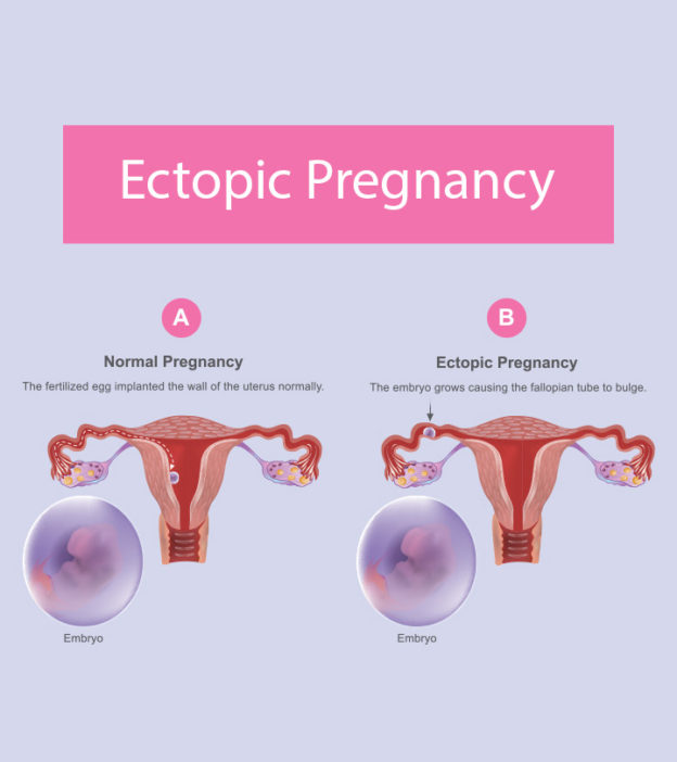 Ectopic Pregnancy: Causes, Symptoms, Treatment, And Risks