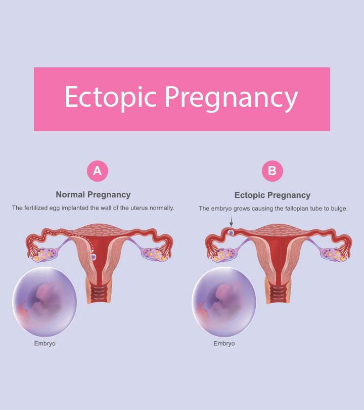 Ovulation Bleeding: Is It Normal? Causes And Symptoms