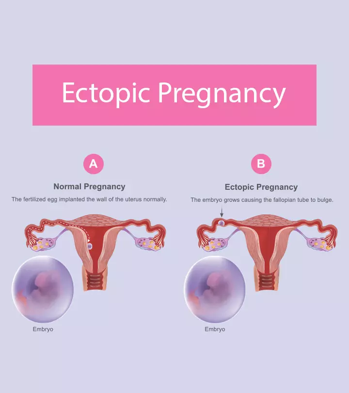 Ectopic Pregnancy Causes, Symptoms, Treatment, And Risks