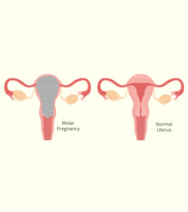 Molar Pregnancy: Types, Symptoms, Causes And Treatment