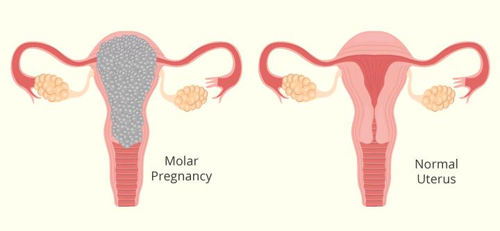 Molar Pregnancy: Symptoms, Causes And Treatment