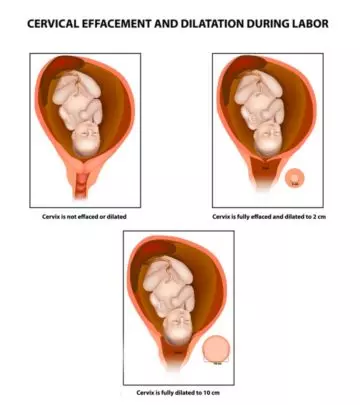 Cervix Dilation Chart: Signs, Stages And Procedure To Check
