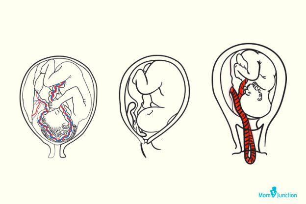 Cord Prolapse: Causes, Diagnosis And Management